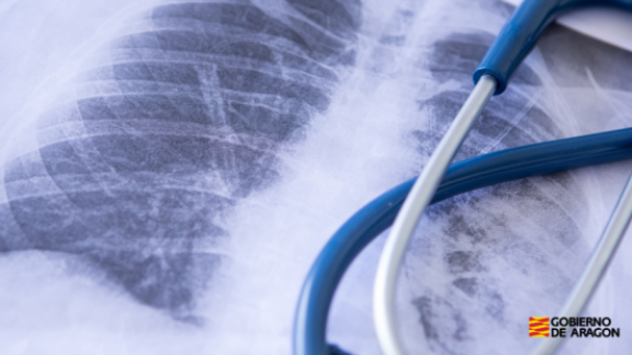 La hipertensión pulmonar, una enfermedad rara que tiene tratamiento