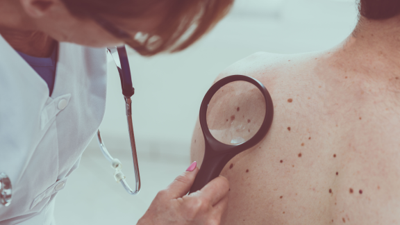 El diagnóstico precoz, clave para evitar el cáncer de piel