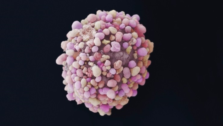 Célula de cáncer de mama. / Foto: EP